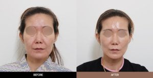 Результаты эндоскопической подтяжки лица до и после в URBAN Plastic Surgery, омоложение