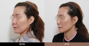 Результаты эндоскопической подтяжки лица до и после в URBAN Plastic Surgery, омоложение