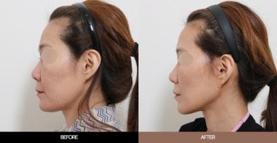 Результаты до и после эндоскопической подтяжки лица в URBAN Plastic Surgery, омоложение