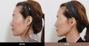 Результаты до и после эндоскопической подтяжки лица в URBAN Plastic Surgery, омоложение