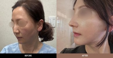 Результаты эндоскопической подтяжки лица до и после в URBAN Plastic Surgery, омоложение лица