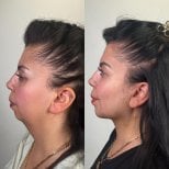 Before and after chin liposuction results at Prof. Furkan Karabekmez's Aesthetic Surgery Clinic