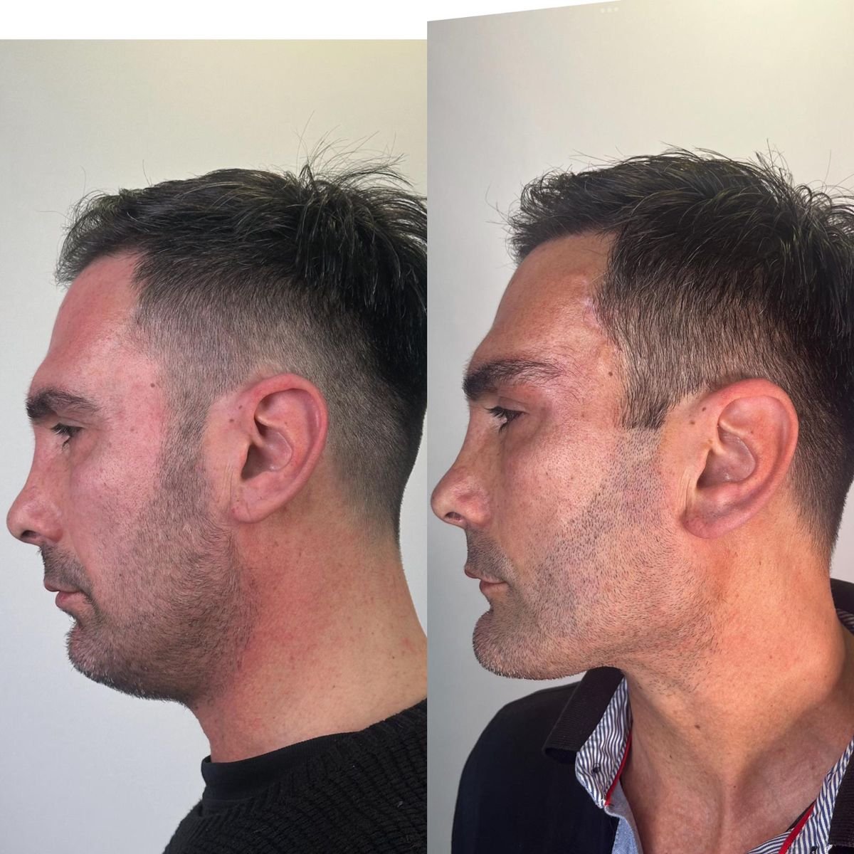 Resultado antes y después de liposucción de mentón en Prof. Furkan Karabekmez's Aesthetic Surgery Clinic