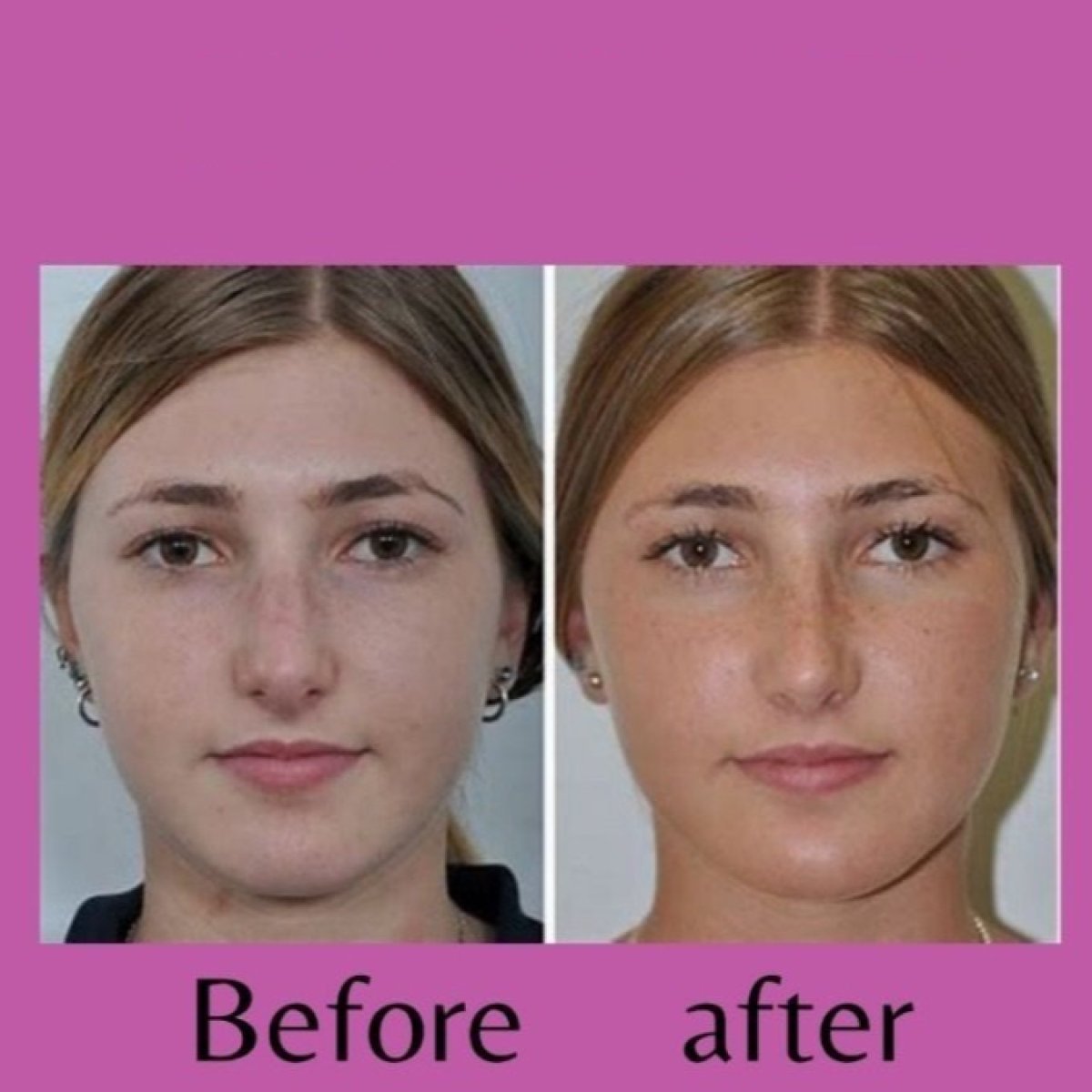 Resultados de rinoplastia antes y después en ID Clinic Bangkok, remodelación nasal natural