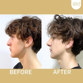 Before and after tip rhinoplasty results at ID Clinic Bangkok, improved nose profile