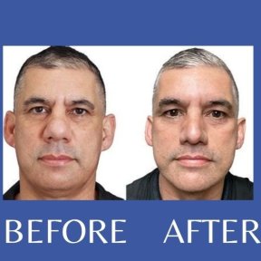 Before and after tip rhinoplasty results at ID Clinic Bangkok, improved nose shape visible