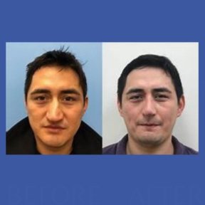 Before and after tip rhinoplasty results at ID Clinic Bangkok, improved nose shape visible