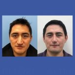 Before and after tip rhinoplasty results at ID Clinic Bangkok, improved nose shape visible