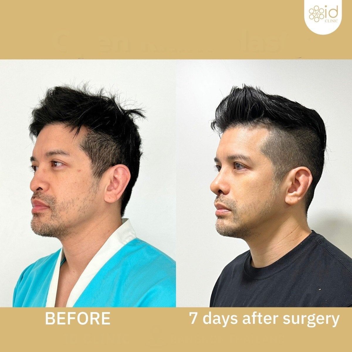 Resultados de rinoplastia de punta en ID Clinic Bangkok, refinamiento nasal visible en hombre