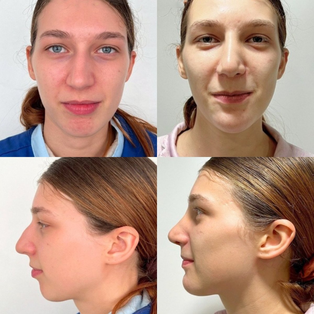 Resultados de rinoplastia antes y después en ID Clinic Bangkok, remodelación nasal natural