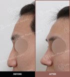 Résultats avant et après rhinoplastie ultrasonique chez URBAN Plastic Surgery, profil du nez amélioré