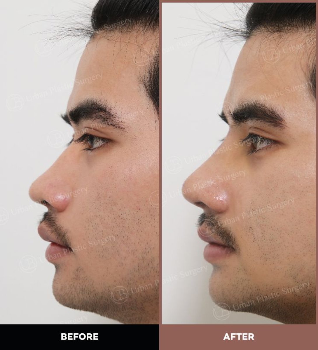 Resultados antes y después de rinoplastia ultrasónica en URBAN Plastic Surgery, perfil nasal mejorado