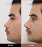 Résultats avant et après rhinoplastie ultrasonique chez URBAN Plastic Surgery, profil nasal amélioré