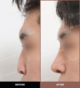 Résultat avant/après rhinoplastie ultrasonique chez URBAN Plastic Surgery, profil du nez amélioré