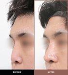 Résultats avant et après rhinoplastie ultrasonique chez URBAN Plastic Surgery, forme du nez améliorée