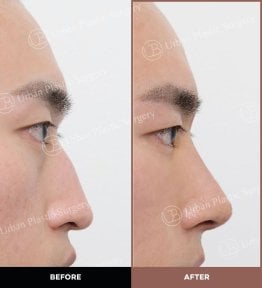 Résultats avant et après rhinoplastie ultrasonique chez URBAN Plastic Surgery, remodelage du nez