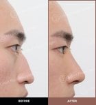 Résultats avant et après rhinoplastie ultrasonique chez URBAN Plastic Surgery, remodelage du nez