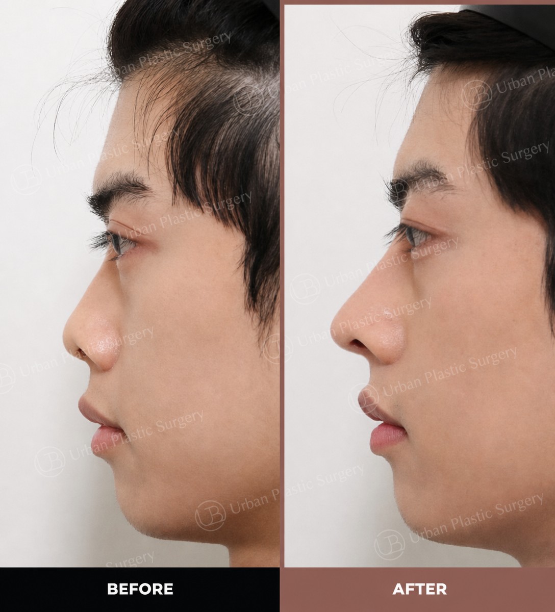 نتائج قبل وبعد تجميل الأنف بالموجات فوق الصوتية في URBAN Plastic Surgery، شكل أنف مصقول