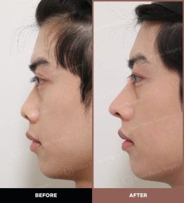 Résultats avant et après rhinoplastie ultrasonique chez URBAN Plastic Surgery, nez affiné