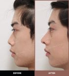 Résultats avant et après rhinoplastie ultrasonique chez URBAN Plastic Surgery, nez affiné
