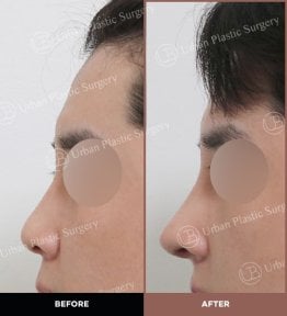 Résultats avant et après rhinoplastie ultrasonique chez URBAN Plastic Surgery, remodelage du nez
