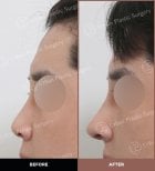 Résultats avant et après rhinoplastie ultrasonique chez URBAN Plastic Surgery, remodelage du nez