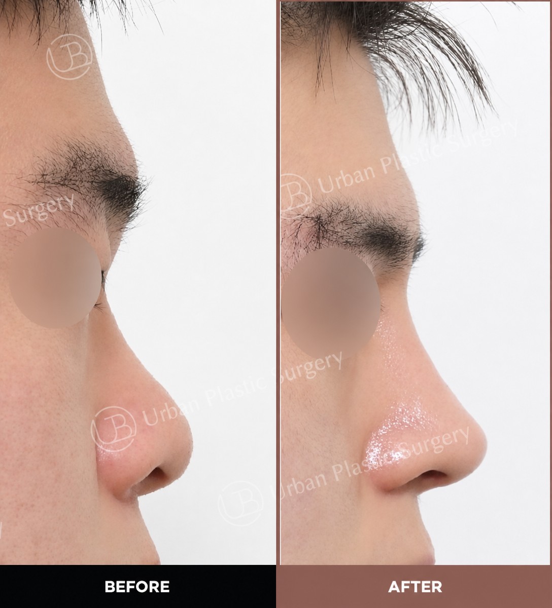 Resultados antes y después de rinoplastia ultrasónica en URBAN Plastic Surgery, perfil nasal mejorado