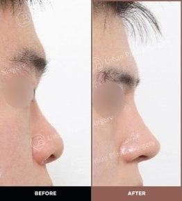 Résultats avant et après rhinoplastie ultrasonique chez URBAN Plastic Surgery, profil nasal amélioré