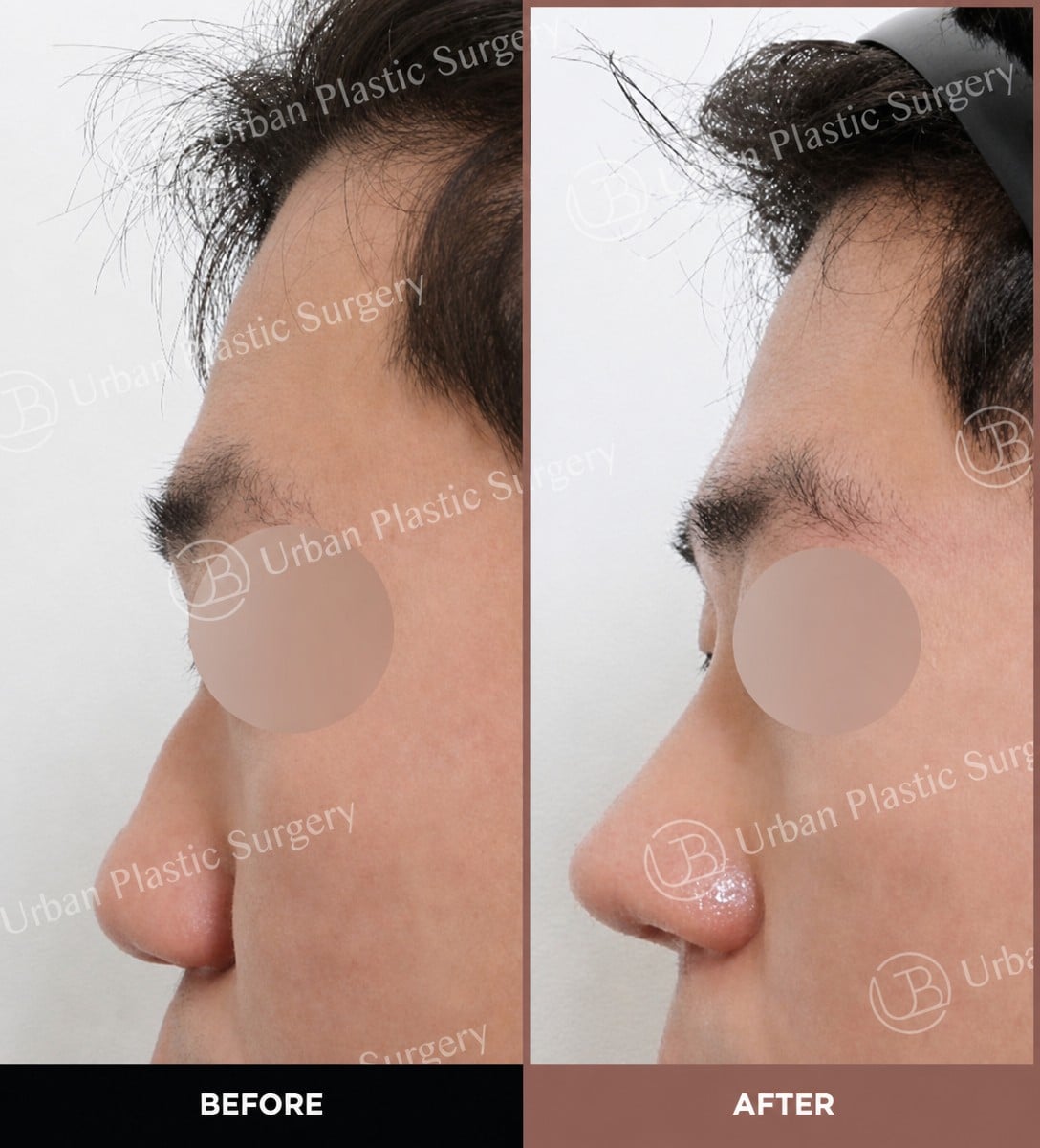 نتائج قبل وبعد تجميل الأنف بالموجات فوق الصوتية في URBAN Plastic Surgery، إعادة تشكيل الأنف
