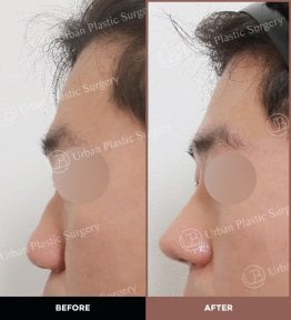 Résultats avant et après rhinoplastie ultrasonique chez URBAN Plastic Surgery, remodelage du nez