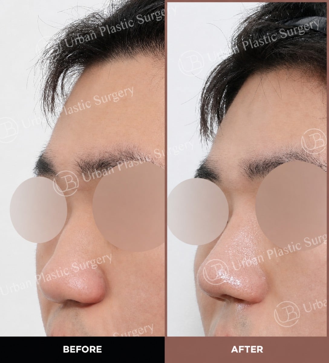نتائج قبل وبعد تجميل الأنف بالموجات فوق الصوتية في URBAN Plastic Surgery، تحسين شكل الأنف