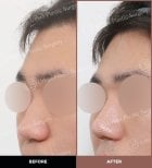 Résultats avant et après rhinoplastie ultrasonique chez URBAN Plastic Surgery, forme du nez améliorée