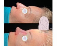 Before and after septoplasty results at Dr. MED, improved nasal profile after surgery