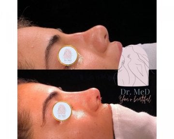Before and after septoplasty at Dr. MED, improved nose shape and breathing result