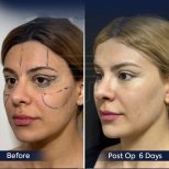 Vorher-nachher-Ergebnis Endoskopisches Facelifting bei Dr. Safa Manav, 6 Tage postoperativ