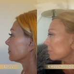 Vorher-nachher-Ergebnis Halsstraffung bei Dr. Safa Manav Clinic, sichtbare Konturverbesserung