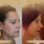 Vorher-nachher-Ergebnis Halsstraffung bei Dr. Safa Manav Clinic, sichtbare Kieferkontur