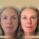 Vorher-nachher-Ergebnis Halslifting bei Dr. Safa Manav Clinic, sichtbare Hautstraffung