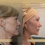 Vorher-nachher-Ergebnis Halsstraffung bei Dr. Safa Manav Clinic, sichtbare Straffung