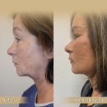 Vorher-nachher-Ergebnis Halsstraffung bei Dr. Safa Manav Clinic, sichtbare Kieferkontur