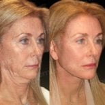Before and after mini facelift results at Memorial Bahçelievler Hospital, facial rejuvenation