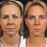 Mini facelift before and after results at Memorial Bahçelievler Hospital, facial rejuvenation
