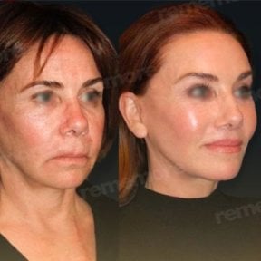 Mini facelift before and after results at Memorial Bahçelievler Hospital, facial rejuvenation