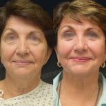Before and after mini facelift results at Memorial Bahçelievler Hospital, facial rejuvenation