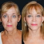 Before and after mini facelift results at Memorial Bahçelievler Hospital, facial rejuvenation