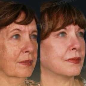 Before and after mini facelift results at Memorial Bahçelievler Hospital, facial rejuvenation