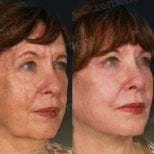 Before and after mini facelift results at Memorial Bahçelievler Hospital, facial rejuvenation