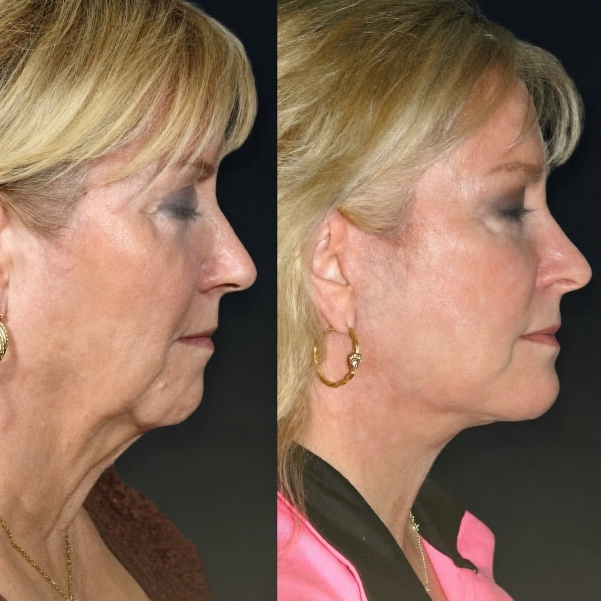 Resultados de minilifting facial antes y después en Memorial Bahçelievler Hospital, rejuvenecimiento