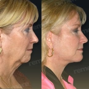 Before and after mini facelift results at Memorial Bahçelievler Hospital, facial rejuvenation