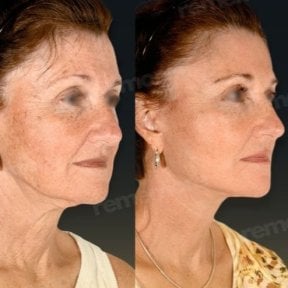 Before and after mini facelift results at Memorial Bahçelievler Hospital, facial rejuvenation